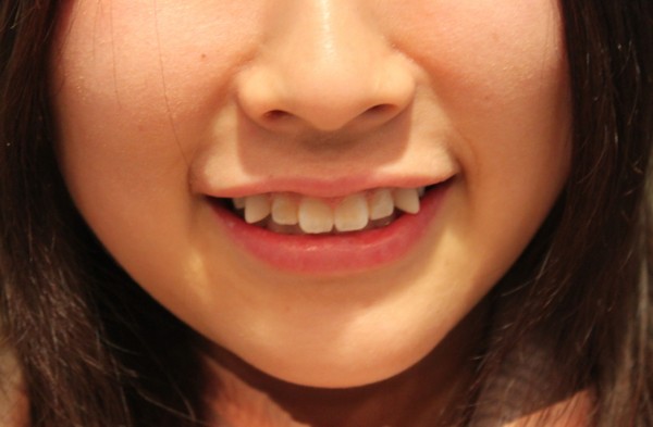 Apakah wanita dengan gigi gingsul (Yaeba) itu imut? Di Jepang, para wanita menemukan kecantikan dalam ketidaksempurnaan